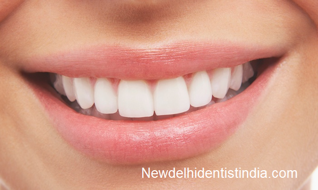 Who Is A Right Candidate For Teeth Bleaching